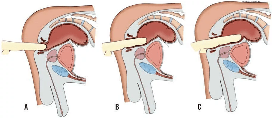 Rectal examination of the finger
